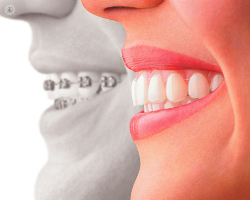 Perfil de dos bocas con ortodoncia: brackets e invisible - maloclusión - by Top Doctors