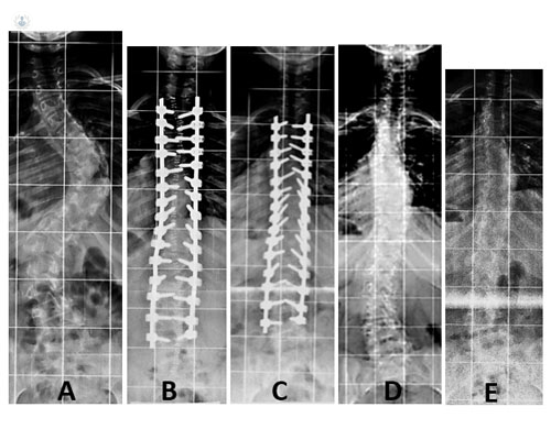 Radiografías de una paciente del Dr. Burgos con escoliosis - by Top Doctors