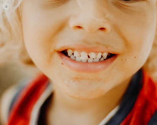 Niño sonriendo mostrando un diente roto - traumatismo dental by Top Doctors
