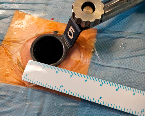 medir-tubo-cirugia-invasiva