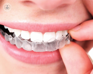 Invisalign® es un sistema de ortodoncia muy cómodo para el paciente, y prácticamente imperceptible