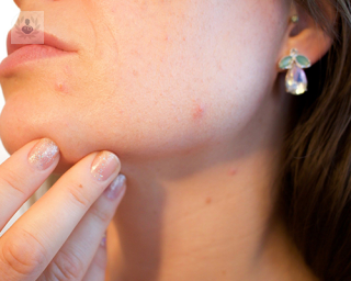 Aproximadamente el 80% de personas tendrán acné en algún momento de su vida.