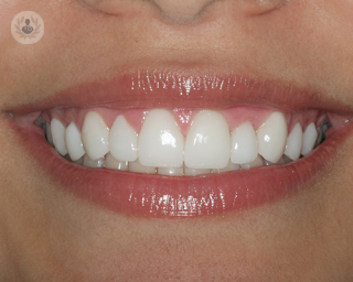 implantes dentales, implante, sonrisa