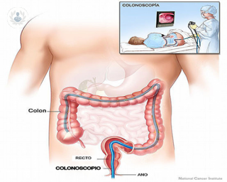 La colonoscopia es una prueba de gran importancia para diagnosticar y prevenir el cáncer colorrectal