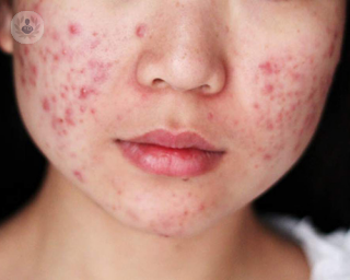 acne_piel_sintomas_tratamiento_cara_adolescencia