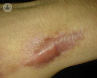 ¿Cómo tratamos las cicatrices hipertróficas y los queloides?
