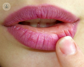 Las llagas son pequeñas úlceras o heridas que aparecen en la boca
