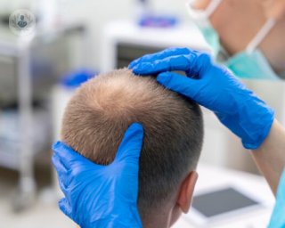 alopecia caida cabello estres tratamientos