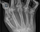En este artículo el Dr. Martín Mola explica los síntomas y el tratamiento de la artritis reumatoide.