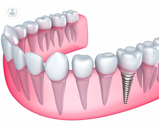 Un implante dental consiste en la colocación de una pieza de titanio en el interior del hueso maxilar que actúa como una raíz artificial.