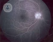 La degeneración macular es una patología que incapacita la visión al paciente. Descubre todos los detalles en el siguiente artículo.