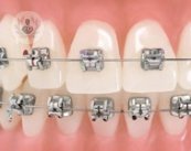 Conoce las diferencias entre los tipos de ortodoncia: lingual, traidicional e invisible en este artículo.