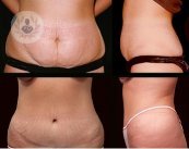 antes y despues abdominoplastia