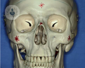 La cara está formada por huesos que no siempre pueden absorber un impacto. Entonces produce una fractura. El Dr. Ots Feliciano te informa