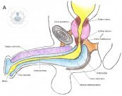 uretra masculina estenosis
