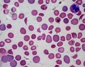 La anemia es la dificultad o disminución del transporte de oxígeno al resto de tejidos a través de los glóbulos rojos. El Dr. Alcaraz te informa. 