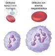 La anemia megaloblástica provoca una disminución de glóbulos rojos, aunque estos tienen gran tamaño. El Dr. Alcaraz, hematólogo, informa