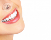 ortodoncia lingual chica