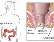 Imagen fistula anal