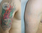 Tatuaje eliminado con láser