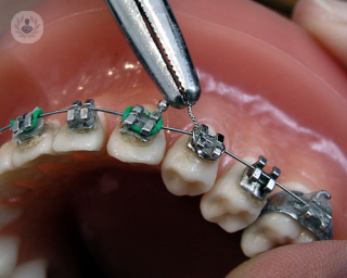 El tratamiento de ortodoncia tiene una duración de entre año y medio y dos años