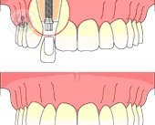 En los implantes dentales se coloca un tornillo de titanio en el hueso o mandíbula, para poner después el diente. El Dr. Román informa