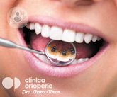 La ortodoncia lingual corrige la dentadura sin que se vean los brackets. La Dra. Olmos, odontóloga, te informa.