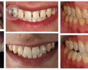 El blanqueamiento dental es una de las técnicas más conservadoras en odontología estética para cambiar el color de los dientes.
