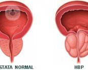 La hiperplasia benigna de próstata no es más que el agrandamiento de la glándula