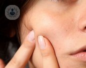 Conoce cómo resolver el acné y sus falsos mitos gracias a este artículo.