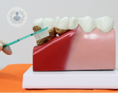 La periodontitis es una enfermedad que cursa con encías que sangran, engrosadas o rojizas, así como dientes móviles o halitosis.