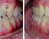 reduccion tratamiento ortodoncico