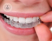 El sistema Invisalign es una de las ortodoncias más solicitadas por los adultos