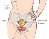 La incontinencia urinaria es más frecuente a partir de los 65 años. La malla ajustable es el mejor tratamiento. 