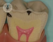 caries inicial 