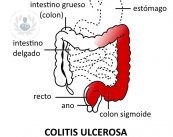 La colitis ulcerosa afecta a la capa interna de colon y recto, produciendo hemorragia anal, diarrea, dolor abdominal, pérdida de peso o fiebre.