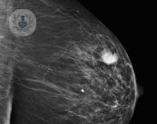 Operación del cáncer de mama sin cicatrices