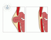 Causas de la aparición de la hernia umbilical