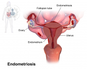 Que es la endometriosis