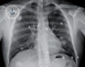 Diagnostico de lo nodulos pulmonares