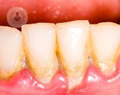 riesgo de periodontitis