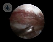 riesgos artroscopia de hombro by Topdoctors
