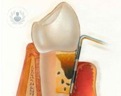 periodoncia periodontitis