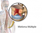 El mieloma múltiple es un tipo de tumor de la sangre