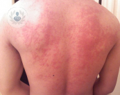 La dermatitis alérgica es una inflamación de la piel causada por el contacto con una sustancia