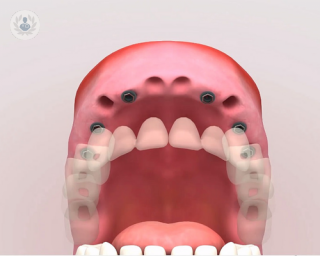 Los implantes dentales son raíces artificiales para sustituir piezas perdidas.