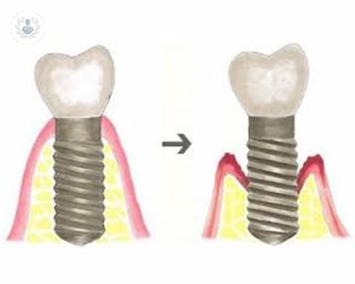 implantes dentales complicaciones