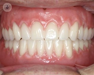 Conoce en qué consiste la prótesis dental completa y los cuidados que requiere gracias a este artículo.