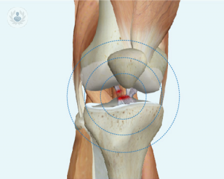 El ligamento cruzado anterior está en el interior de la articulación de la rodilla.