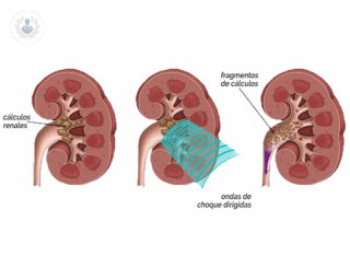 Los cálculos renales se forman en el riñón y pueden ser perjudiciales.